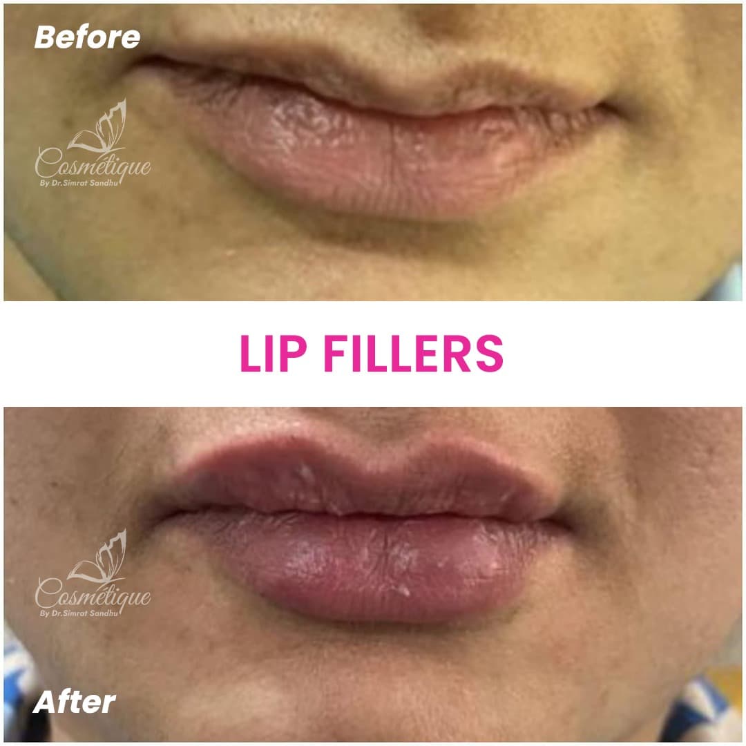 Before and After 2